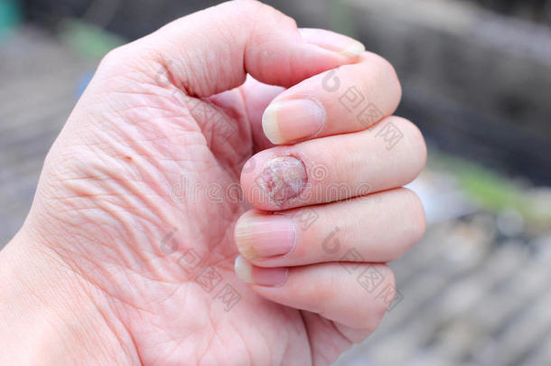 真菌感染指甲手，手指甲真菌病。 -集中注意力