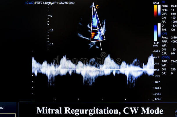 彩色超声监测图像。 二尖瓣反流