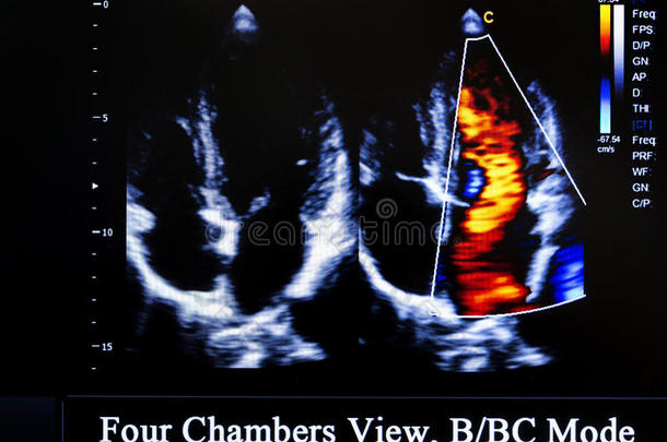 彩色超声监测图像。 四个房间