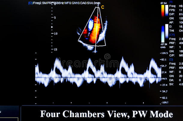 彩色<strong>超声</strong>监测图像。 四个房间