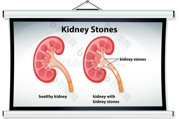显示<strong>肾结石</strong>的图表