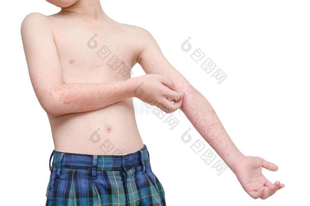 孩子擦伤皮肤有皮疹