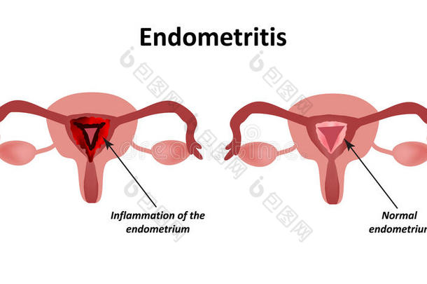 <strong>子宫</strong>内膜炎。 <strong>子宫</strong>内膜炎症。 <strong>子宫</strong>的炎症。 信息图形矢量插图上