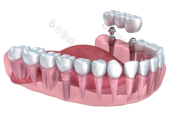 三维下牙和<strong>种植牙</strong>透明渲染