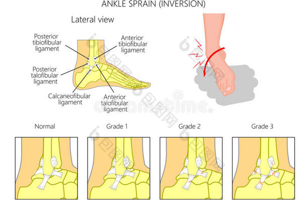 <strong>脚踝</strong>扭伤。倒置