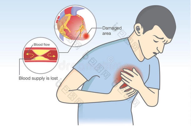 <strong>血液流</strong>动引起的心脏病发作症状被阻断。