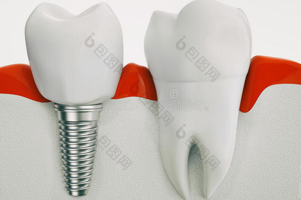 健康<strong>牙齿</strong>和牙<strong>种植</strong>体在颌骨三维渲染中的解剖
