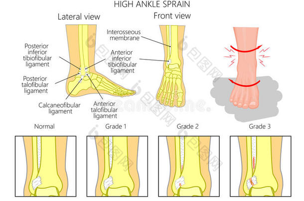 疼痛踝关节清晰度绷带骨