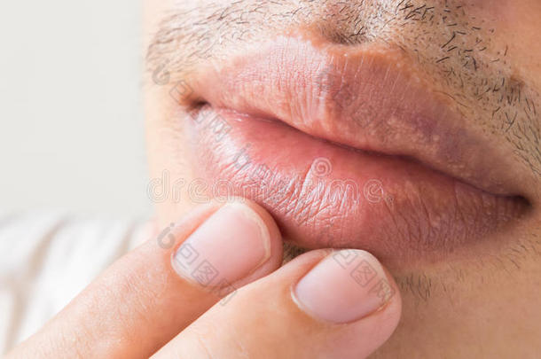 嘴唇男人问题的特写保健，单纯疱疹