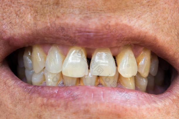特写老年妇女<strong>牙齿问题</strong>与牙龈或牙垢健康