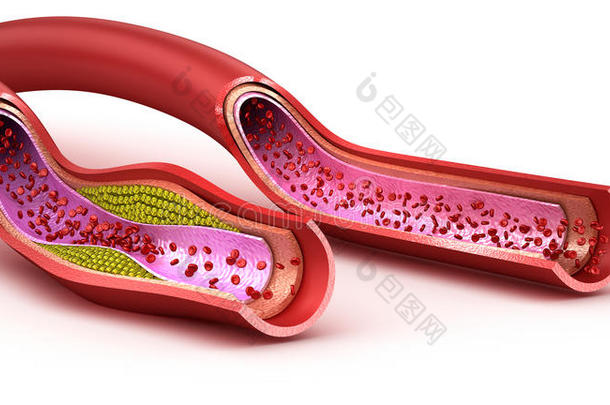 血管：正常和胆固醇受损的血管