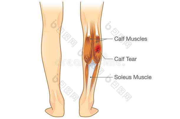 <strong>小腿肌肉</strong>撕裂。