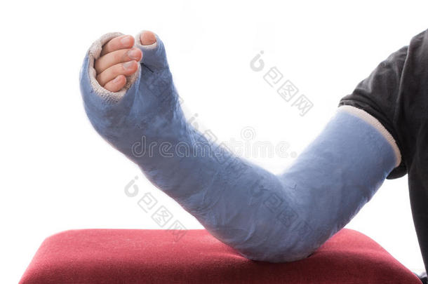 蓝色长臂石膏/玻璃纤维铸造休息在<strong>脚凳</strong>上