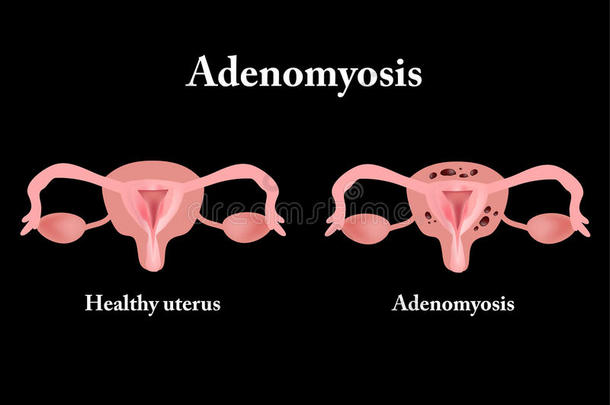 子宫内膜异位症。 盆腔器官的结构。 子宫腺肌病。 子宫内膜。 矢量插图