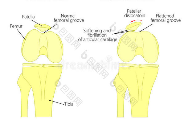 髌骨软骨软化症。 股沟扁平