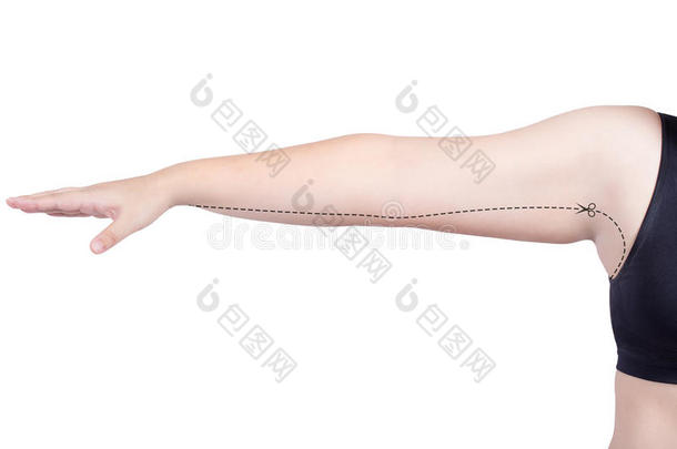 胖女人手术标志手臂切割身体脂肪整形手术吸脂的概念