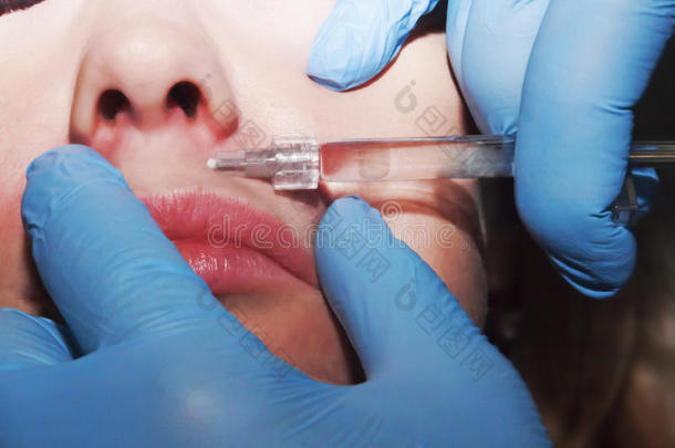 皮肤科医生在嘴唇上用填充物进行轮廓整形