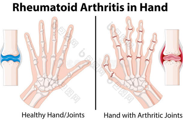 图示<strong>类风湿关节炎</strong>在手