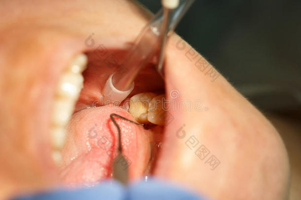 牙科病人检查她的磨牙和牙龈