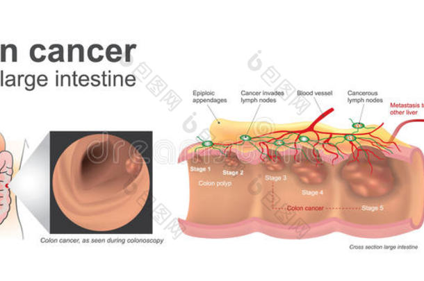结肠癌人类大肠。 解剖学插图，艺术。