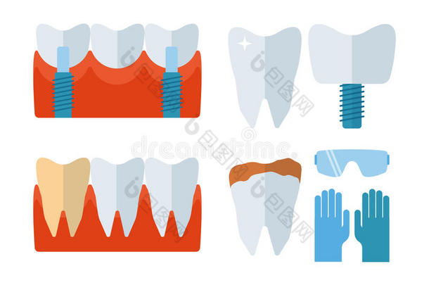 牙科植牙和口腔设备矢量插图。