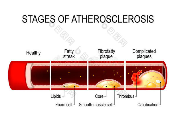 解剖学解剖动脉动脉硬化动脉粥样硬化
