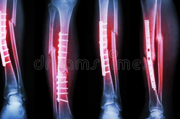 小腿骨折的采集图像及<strong>钢板</strong>内固定手术治疗。 折断胫骨和腓骨