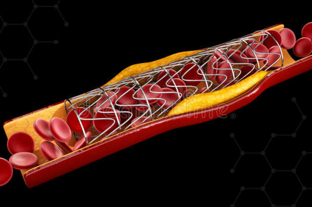 解剖血管成形术动脉血心脏的