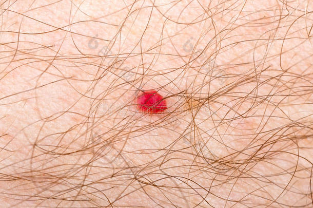 人皮肤上的樱桃血管瘤