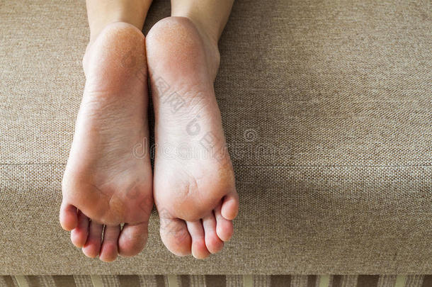 女人脚在床上干裂的皮肤。 足部治疗。