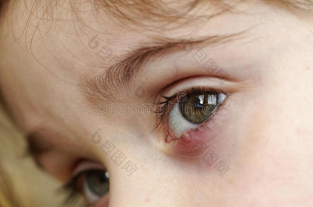 特写一个孩子`眼睛。 眼科大疱病