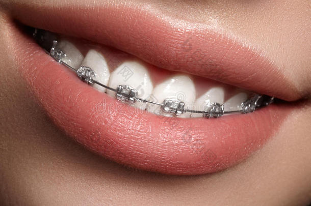 漂亮的白牙和牙套。 牙科护理照片。 女人微笑与牙齿配件。 正畸治疗