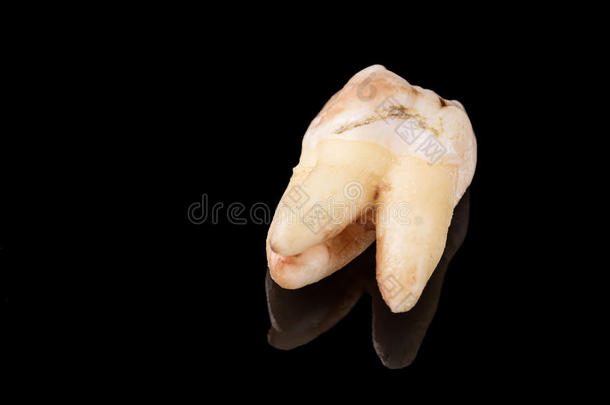 龋齿与龋齿鼠疫的近距离图像，并对黑色进行反射