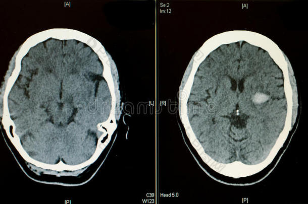 脑ct扫描显示出血中风