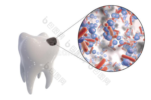 龋齿和导致龋齿的微生物的近距离观察