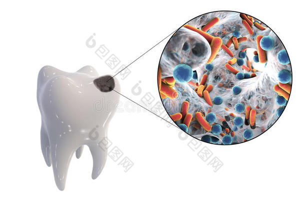 龋齿和导致龋齿的微生物的近距离观察