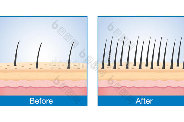 头发在头皮治疗前后脱发。