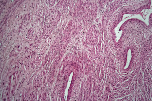 子宫肌瘤的人类子宫细胞