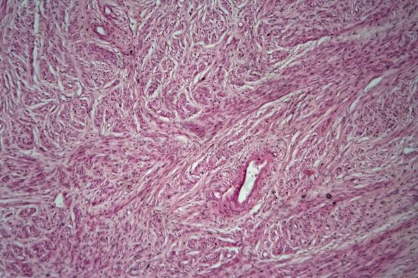 子宫肌瘤的人类子宫细胞