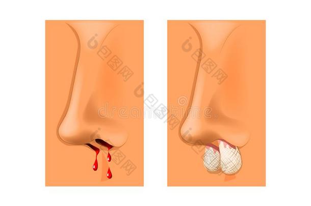 鼻出血,鼻的包装.