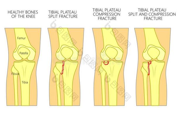 骨头折断_胫骨的高原折断