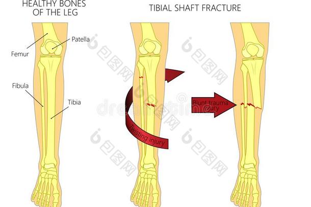 骨头<strong>折断</strong>_胫骨的柄<strong>折断</strong>