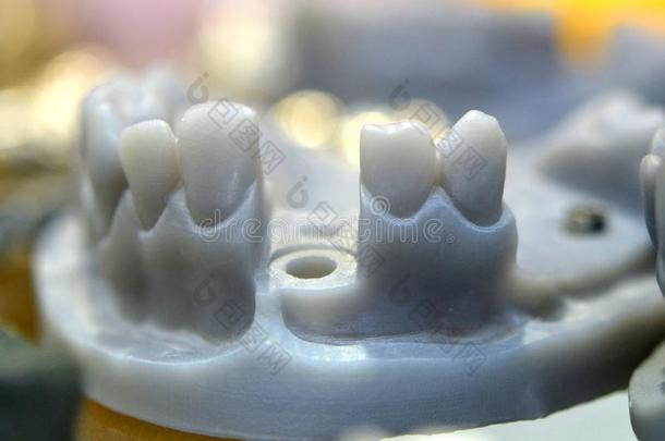 可折叠的下巴模型和牙和洞为指已提到的人移植物王冠