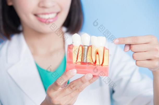 女人牙科<strong>医生</strong>拿移植物牙
