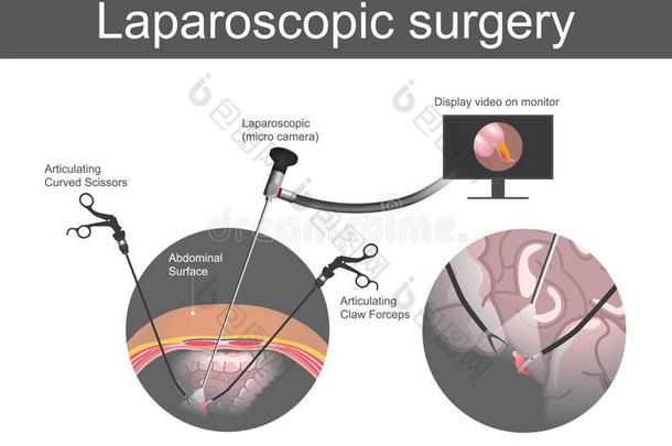 腹腔镜检查的外科学.技术的外科学哪一个操作是由