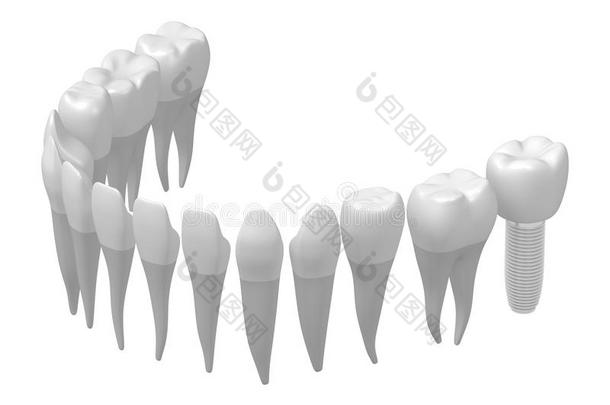 牙齿的移植物/牙移植物