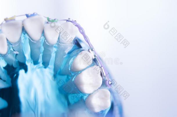 牙齿的牙金属括弧