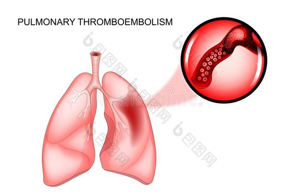 肺的血栓栓塞症.血栓症