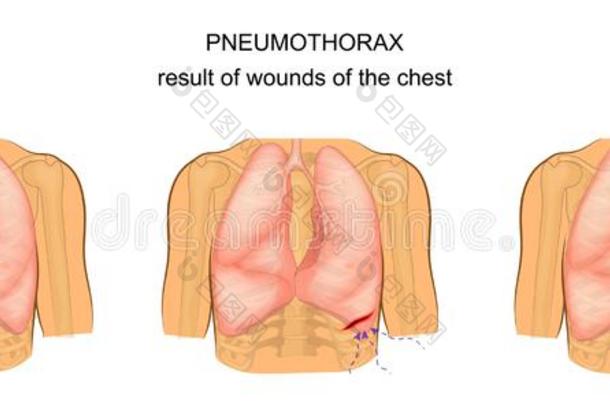 气胸同样地一结果关于创伤关于指已提到的人胸部