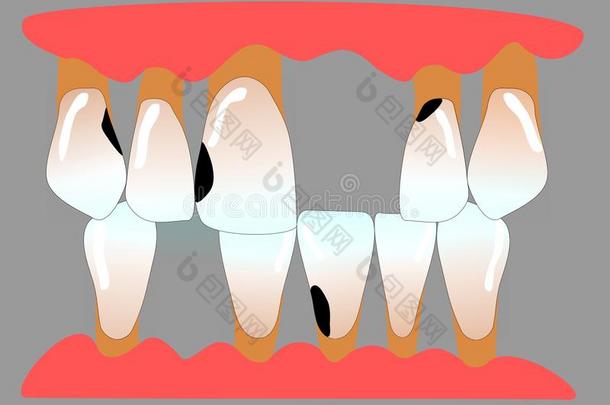 人位于前部的牙和牙空间牙周炎和龋齿